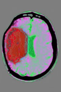 Bioxodes запускает ключевое исследование для нового препарата от геморрагического инсульта
