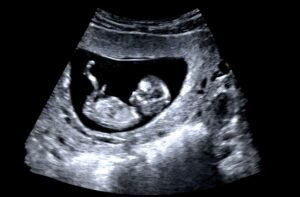 Pulsenmore ES одобрен FDA: домашнее УЗИ приходит в США, устраняя дефицит доступа