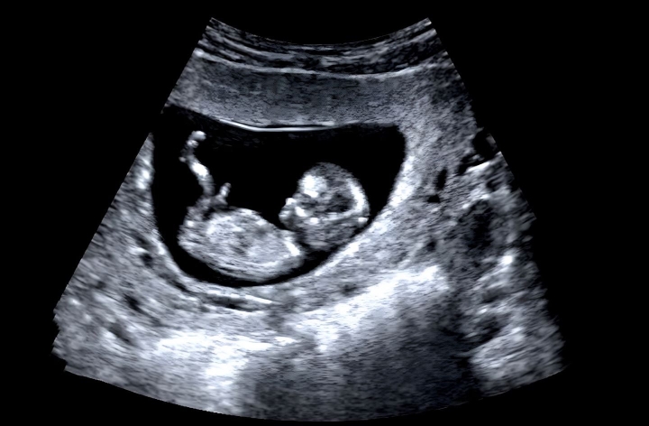 Pulsenmore ES одобрен FDA: домашнее УЗИ приходит в США, устраняя дефицит доступа