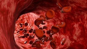 FDA одобрило катетер Recana от InterVene для борьбы с венозным рестенозом